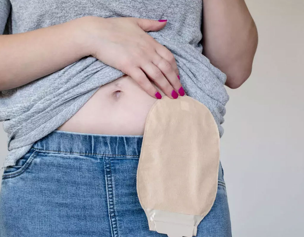 Stoma-Care-at-home