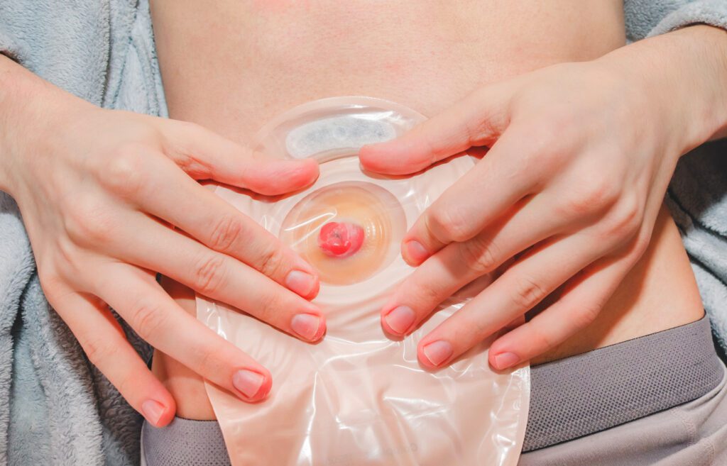 The hands of a young caucasian man hold a colostomy bag on an adhesive circle around the small intestine .